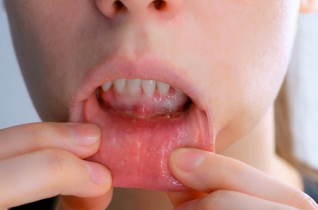 Estomatitis: causas y tratamientos