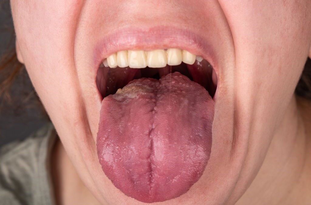 Glositis: causas, síntomas y tratamiento de la inflamación lingual