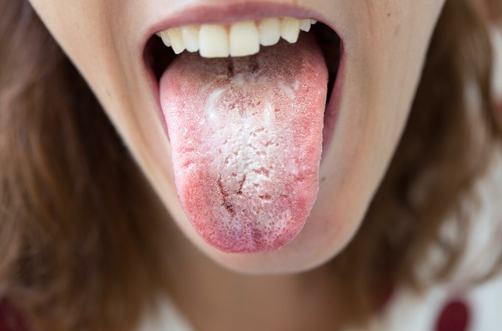 ¿Por qué tengo la lengua blanca?