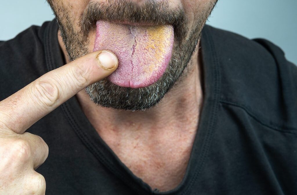 Causas principales de la lengua amarilla