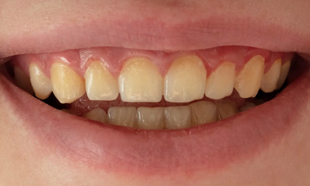 Erosión dental por bebidas ácidas: cómo evitar el desgaste del esmalte