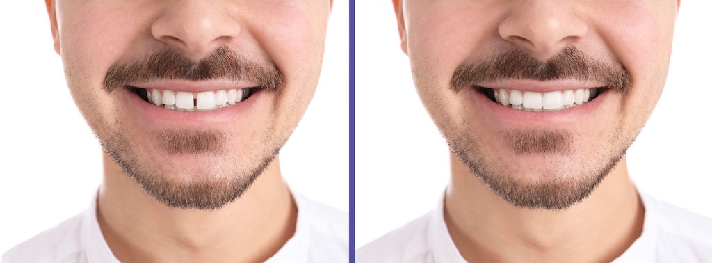 diastema