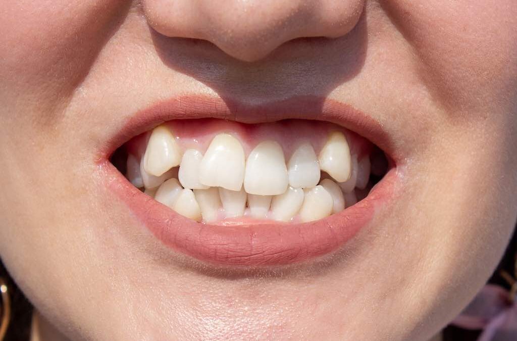 ¿Por qué tratar los dientes apiñados?