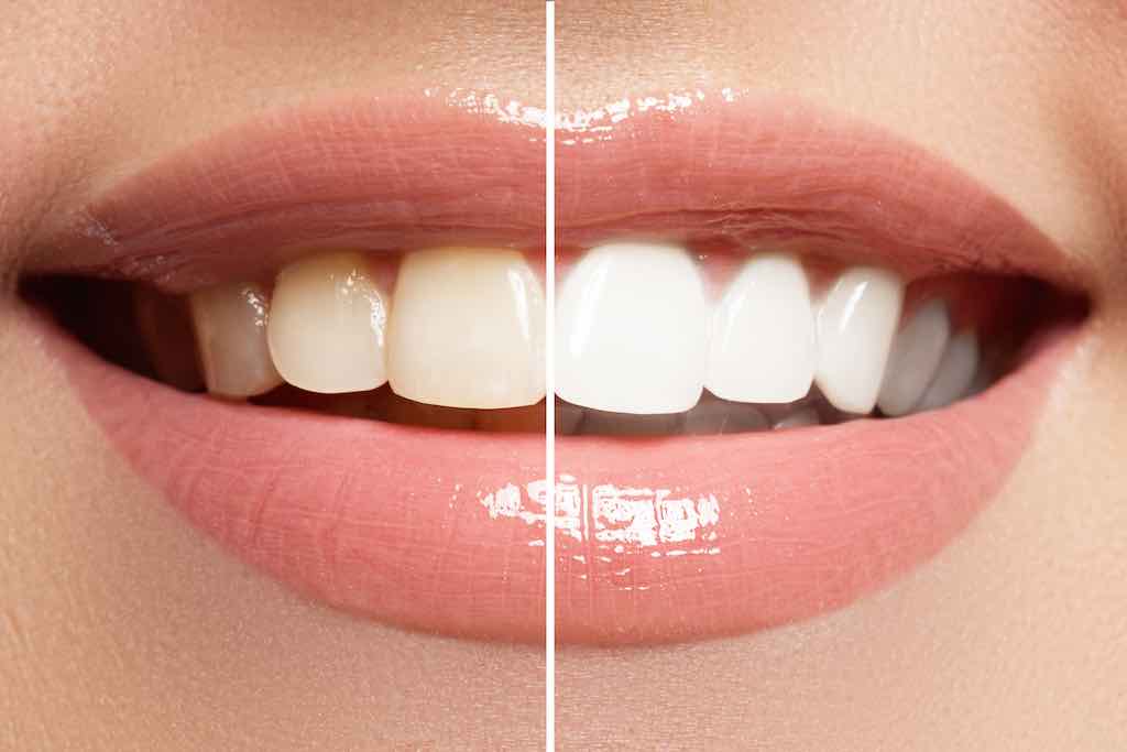 dientes blancos en granada