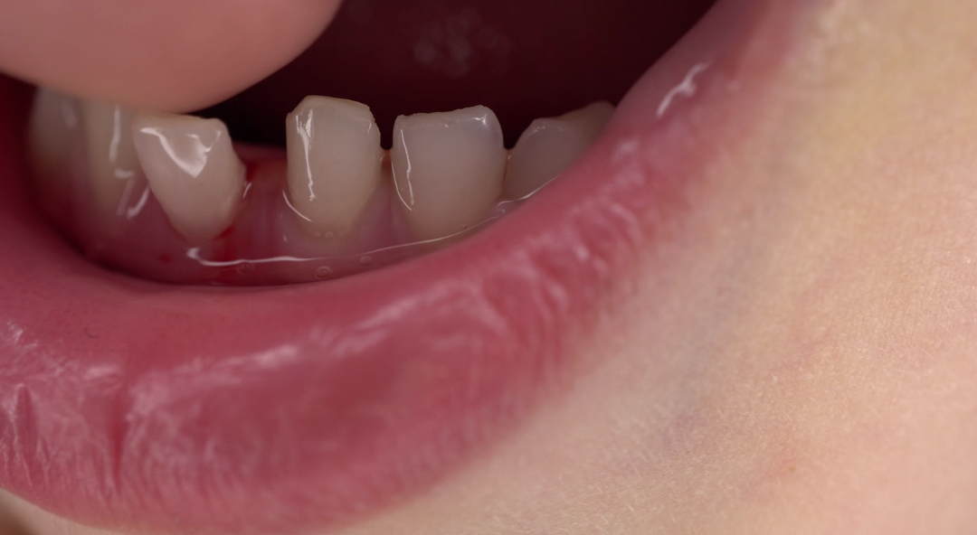 Dientes que se mueven: causas y cuándo debes acudir al dentista