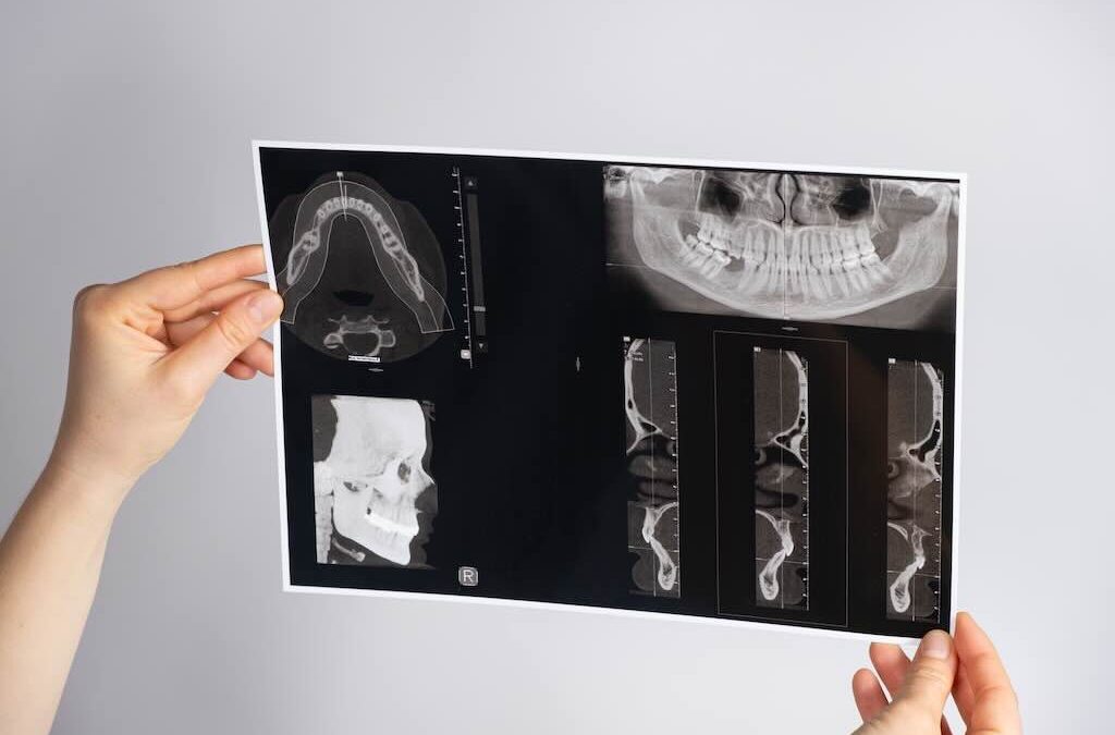 ¿Qué es la disfunción temporomandibular (ATM) y cómo se trata?