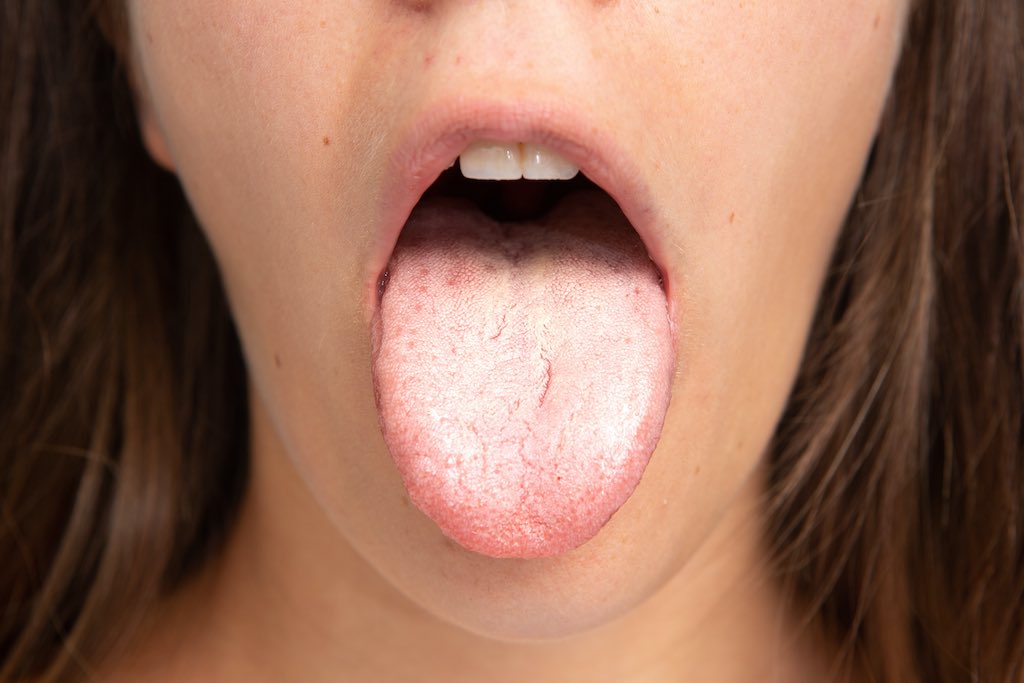 enfermedades bucales lengua