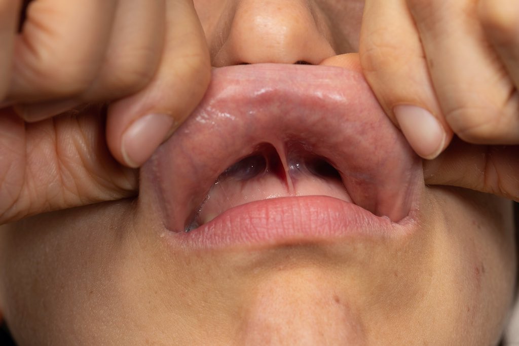 frenillo labial que es