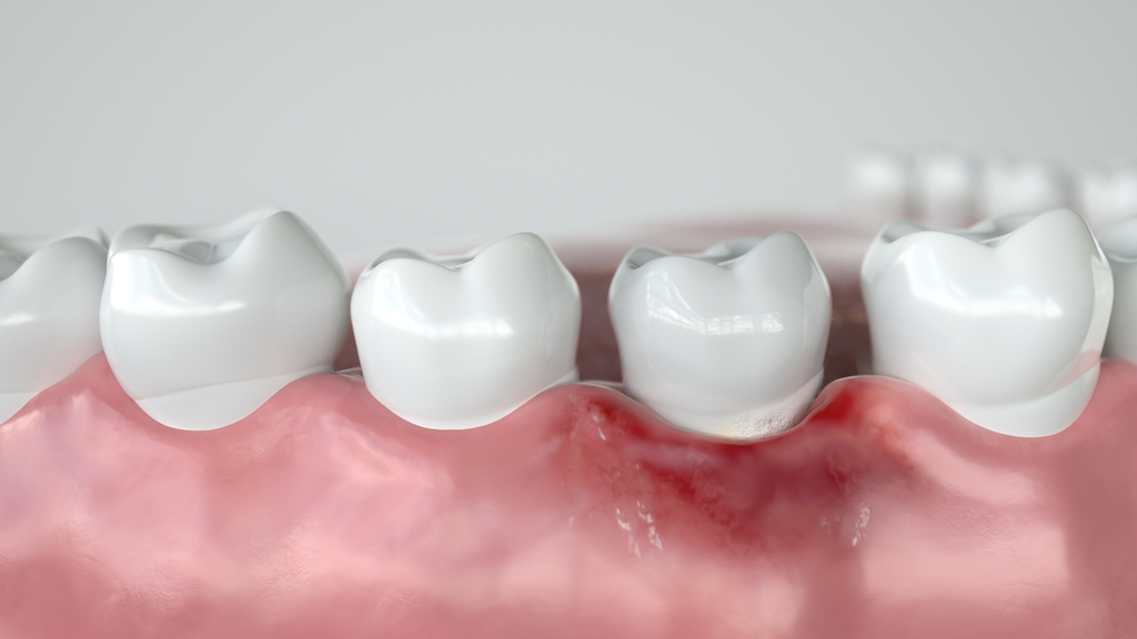 gingivitis