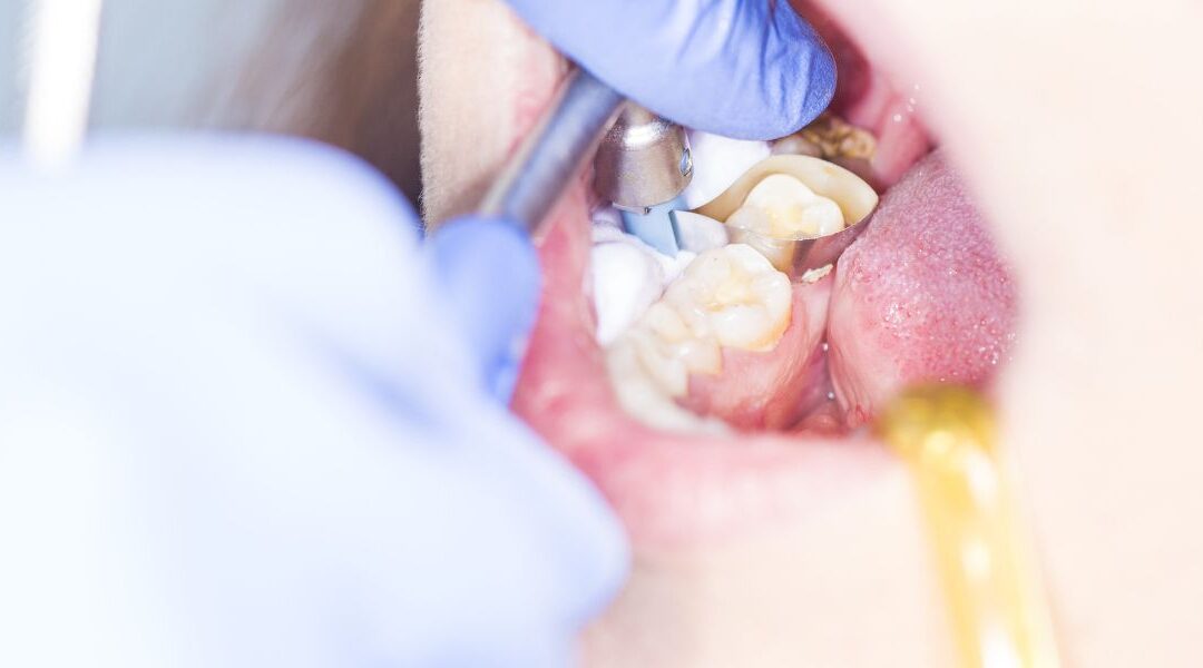 Infección dental: síntomas, causas y cuándo acudir al dentista