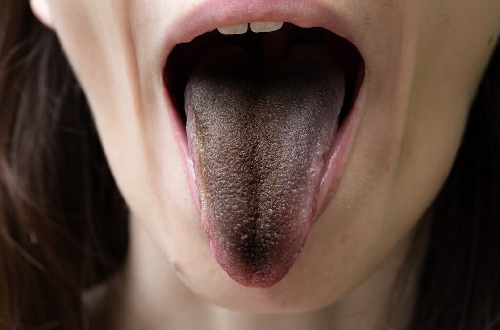 ¿Por qué tengo la lengua negra?