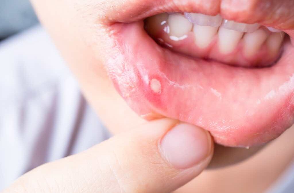 Descubre qué es el Liquen Plano Oral