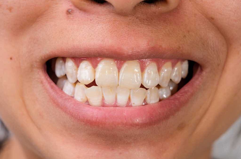 Todo sobre las manchas blancas en los dientes