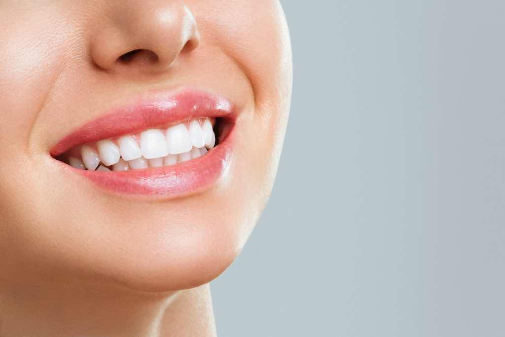 microcarillas dentales que son