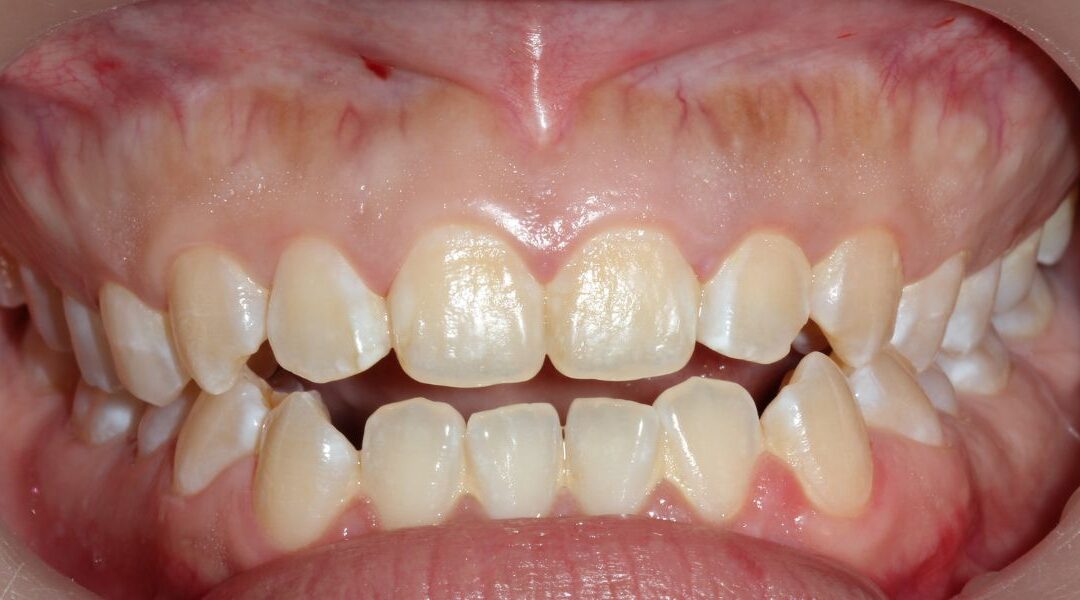 Sensación de mordida rara: cuando los dientes no encajan bien