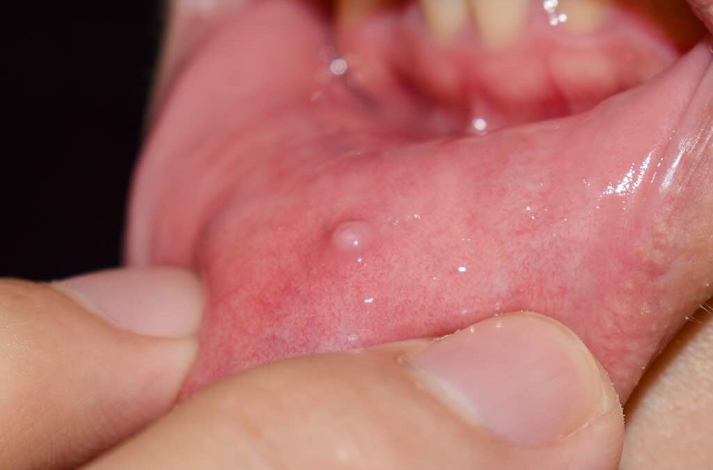 Bolitas en la boca. ¡Descubre qué es el Mucocele!