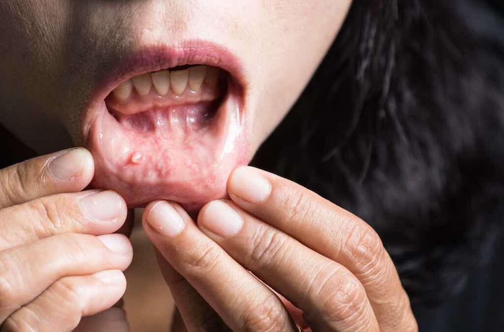 ¿Qué es la mucositis y cuáles son sus síntomas?