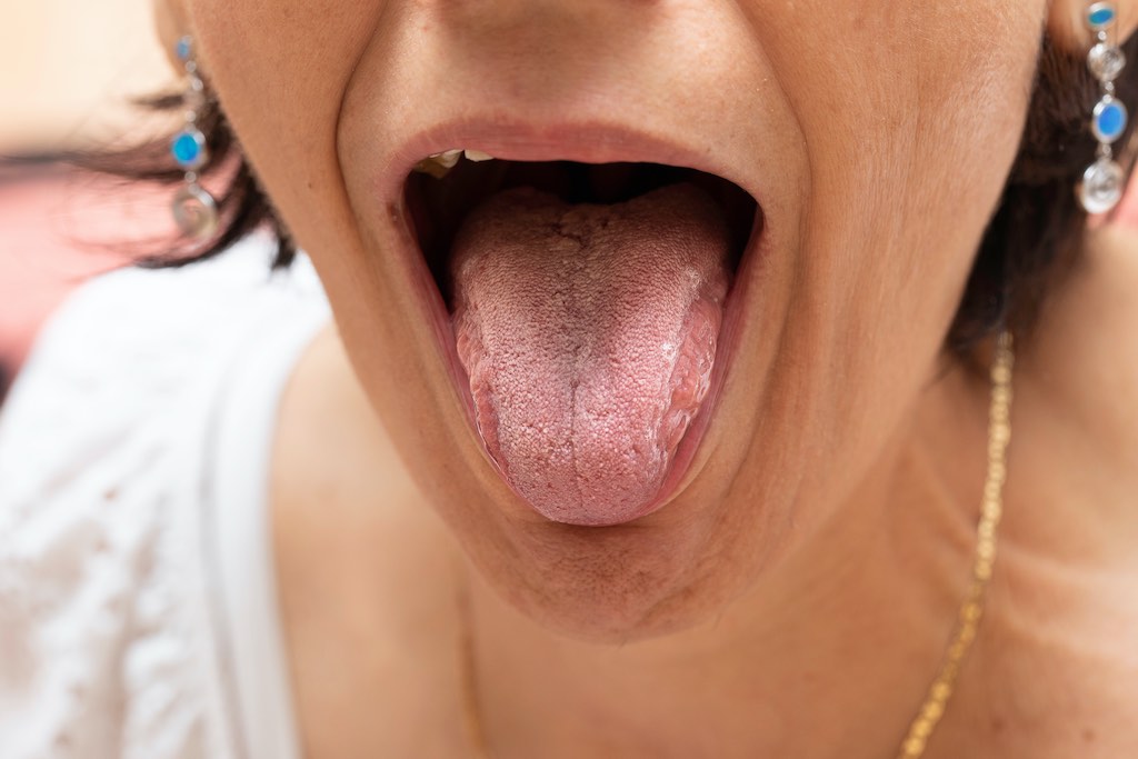 mucositis oral
