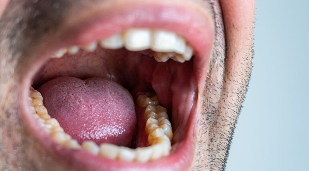 Presión en los dientes: causas más frecuentes y cuándo preocuparse