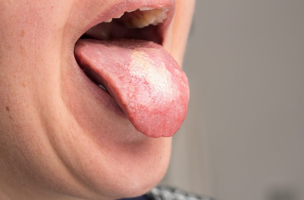 ¿Qué es la mucositis oral?