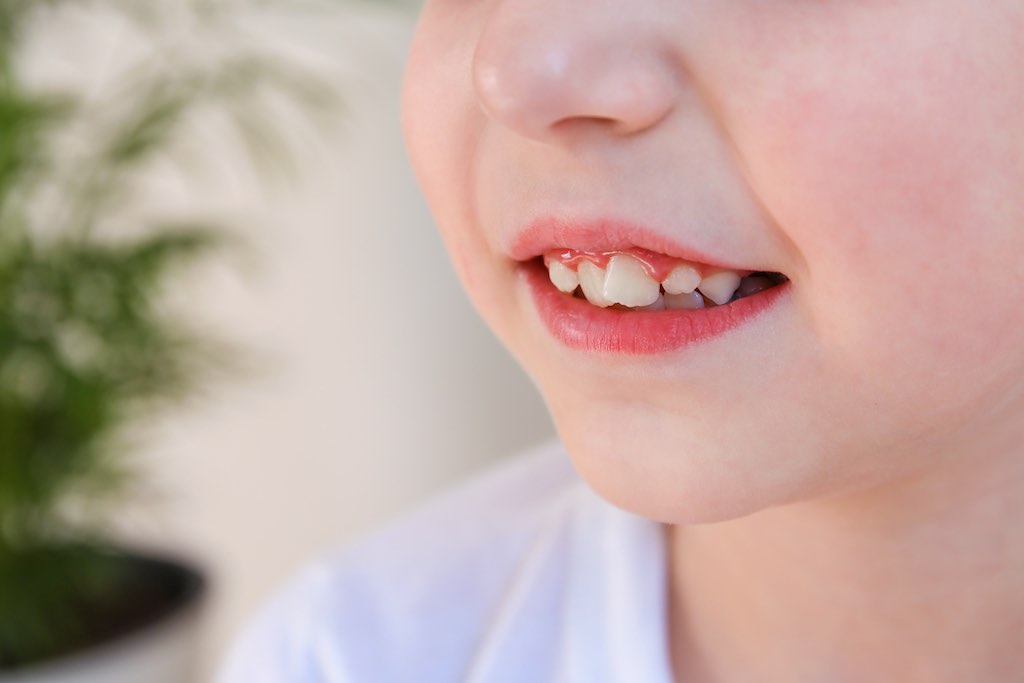 que son dientes apiñados
