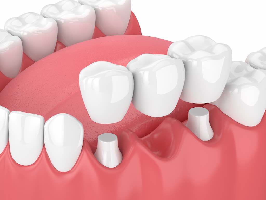 que son los puentes dentales