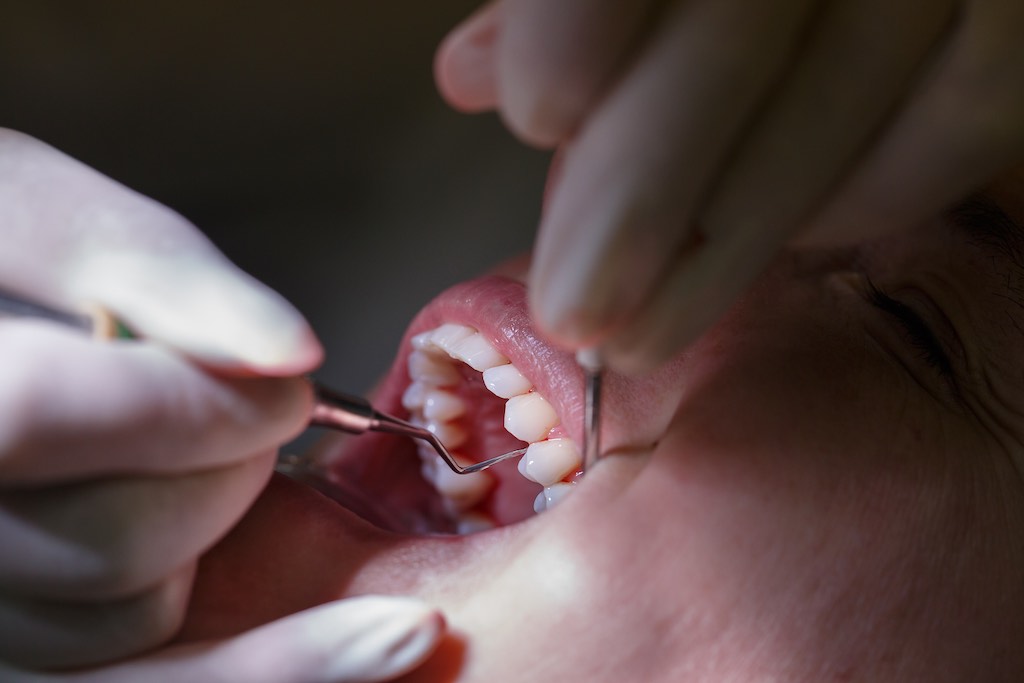 raspado dental