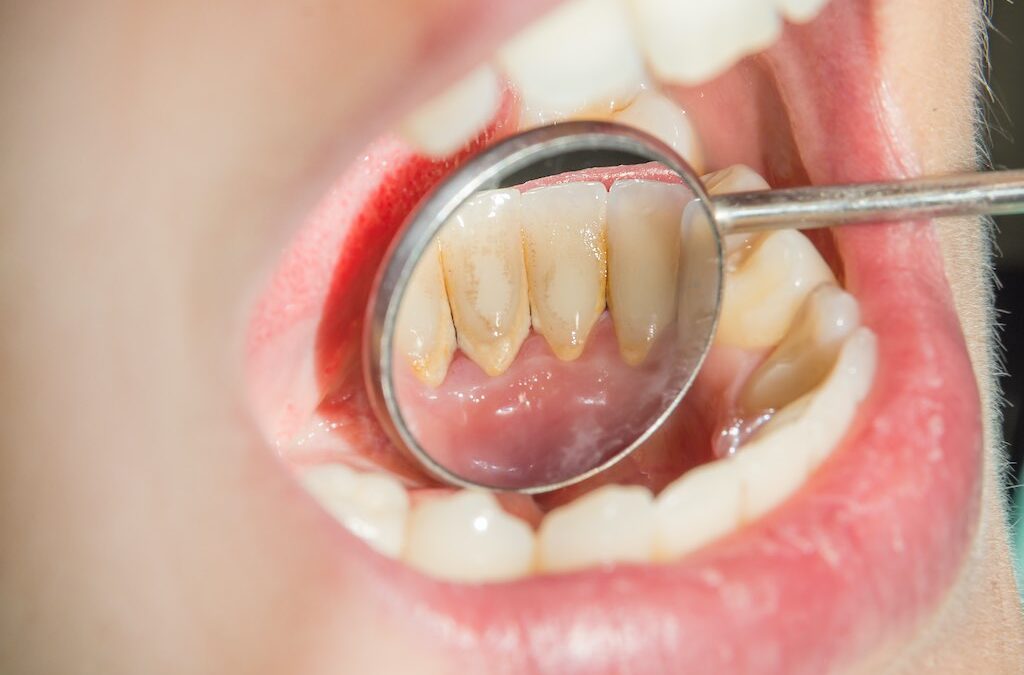 ¿Qué es el sarro dental?