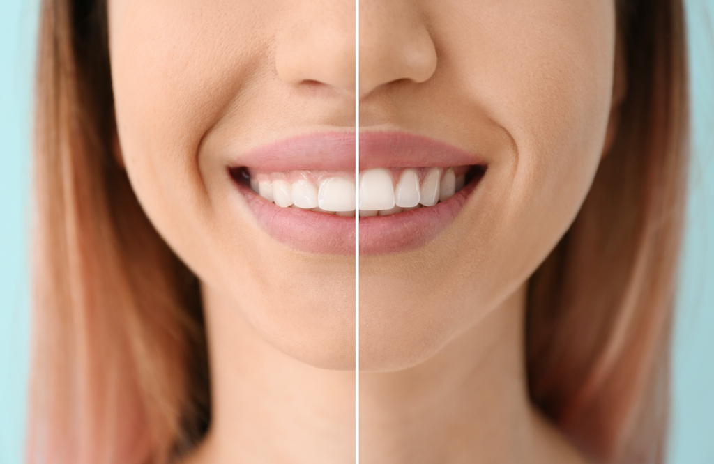 ¿Qué es la sonrisa gingival?