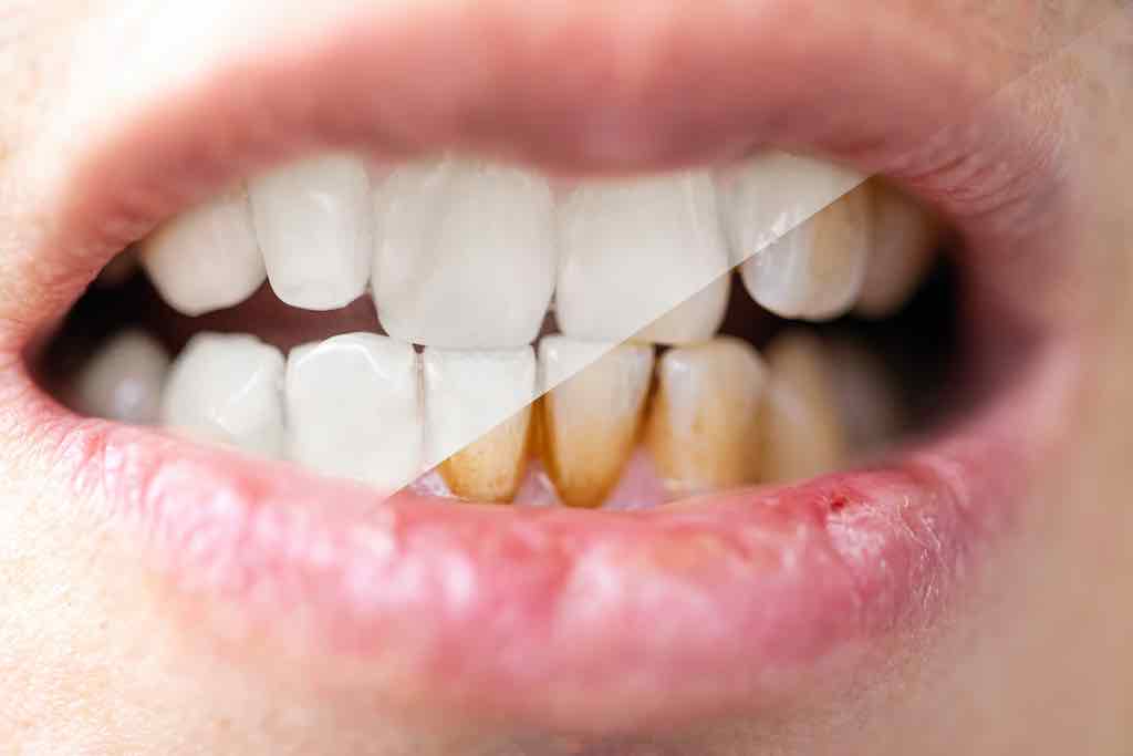 tincion dental