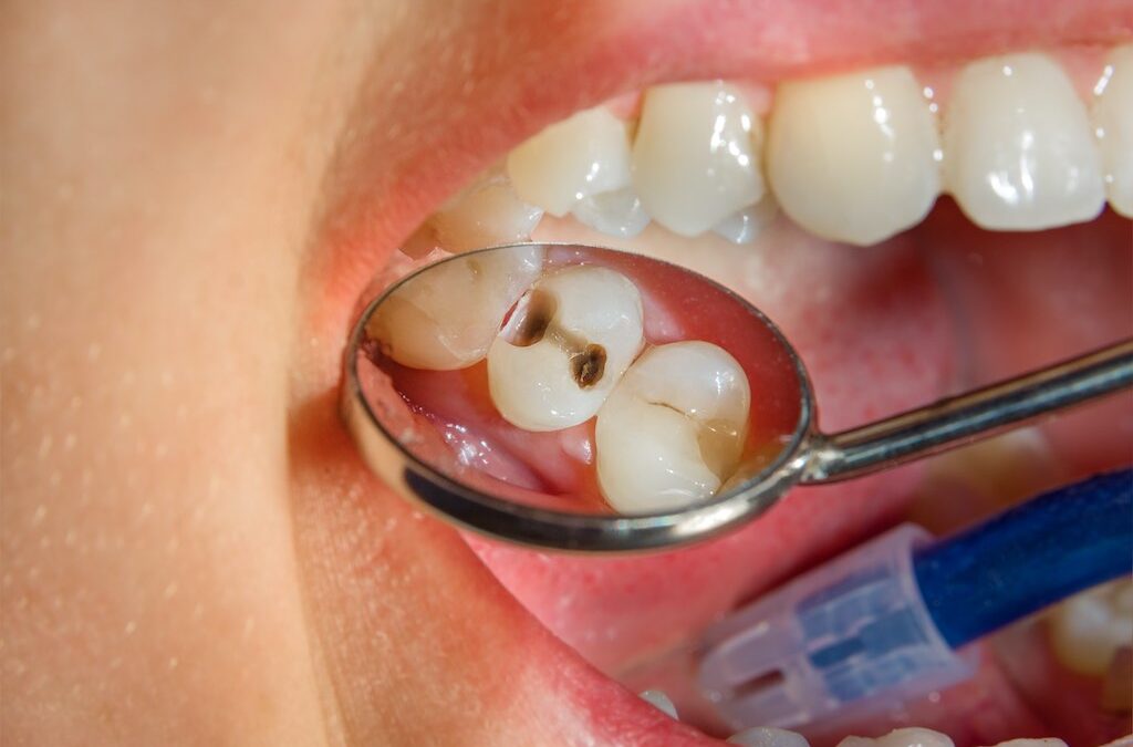Tipos de caries dentales