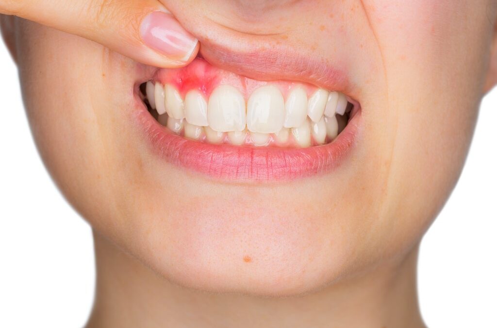 Gingivitis: qué es y cómo se cura